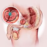 Ingrossamento della prostata e problemi di erezione